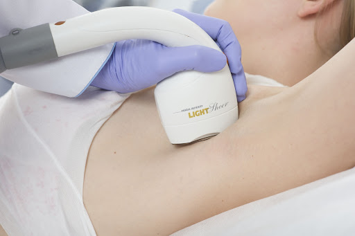 Zabieg depilacji laserowej laserem diodowym - Kosmocare Rybnik